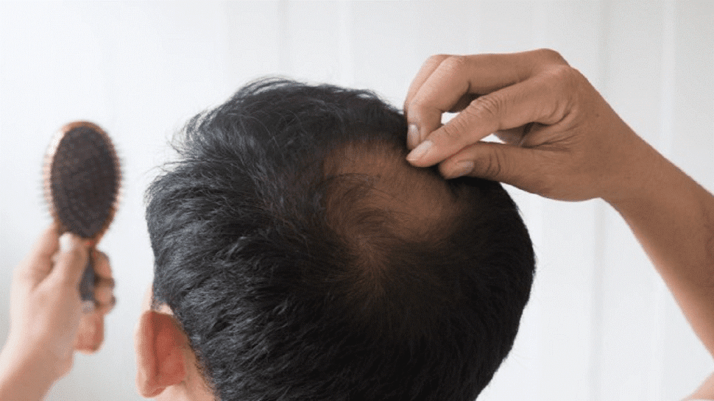 ریزش مو در طول رژیم غذایی